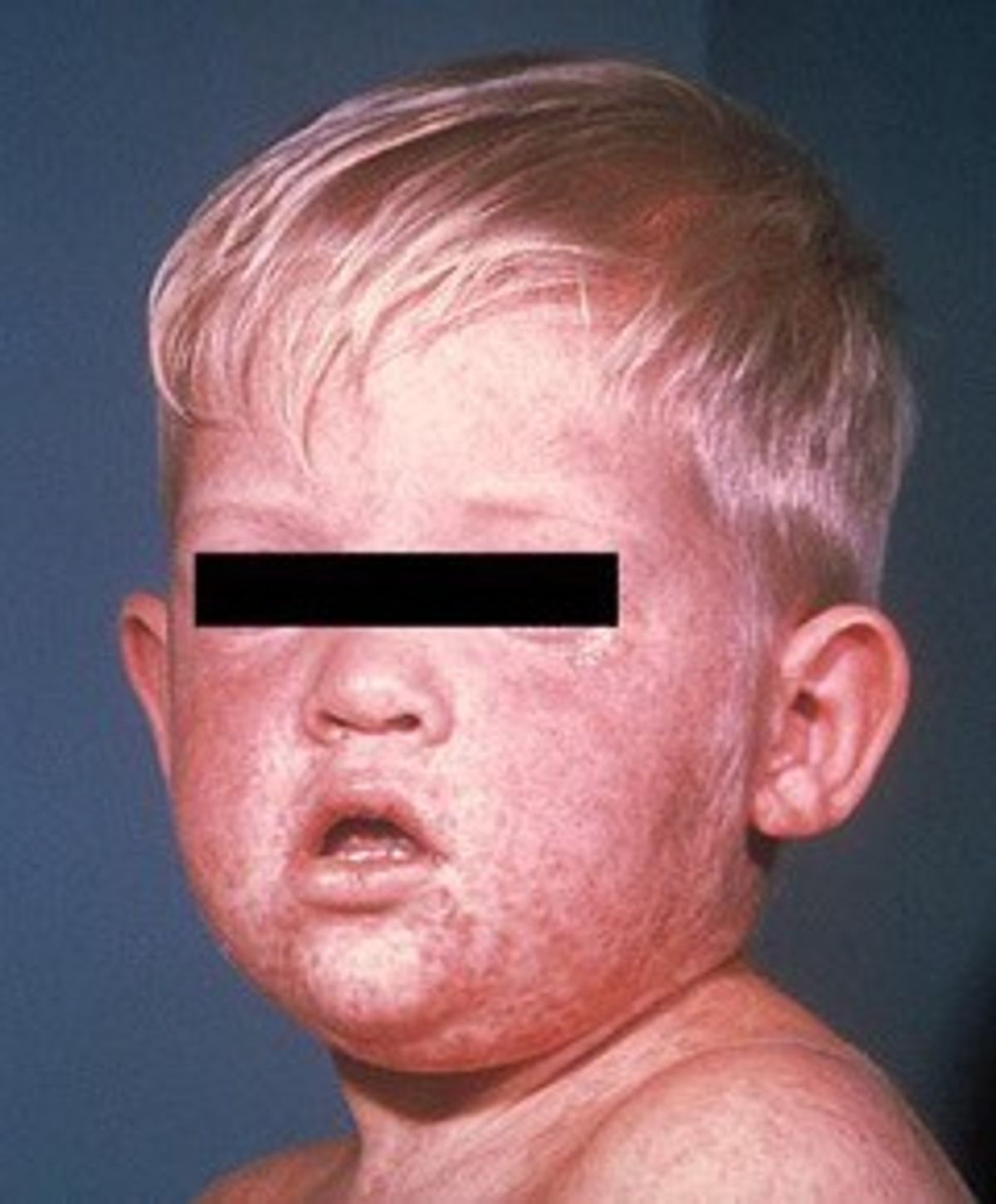 Measles Again! But Why?