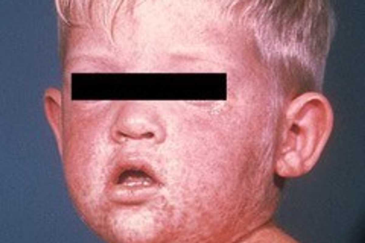 Measles Again! But Why?