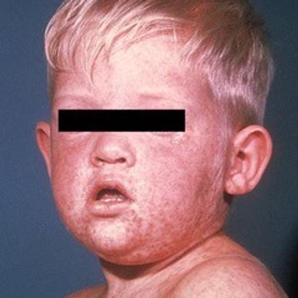 Measles Again! But Why?